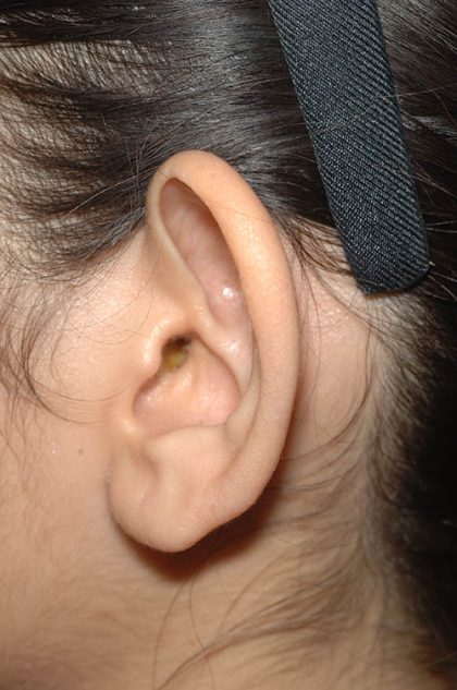 Ear Pinning - Otoplasty Before & After Patient #6118