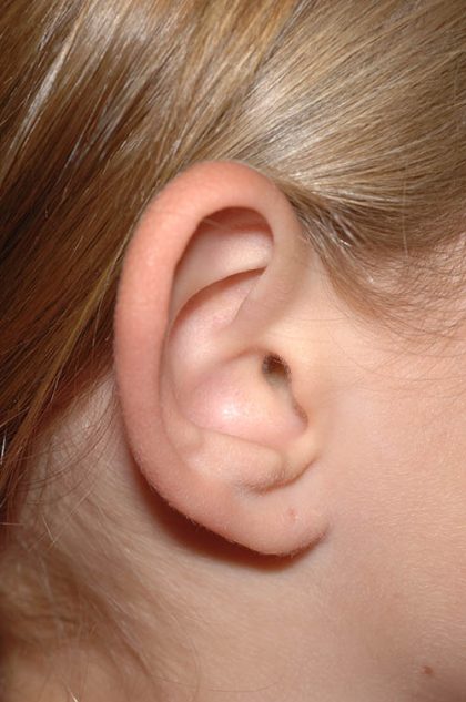 Ear Pinning - Otoplasty Before & After Patient #6122