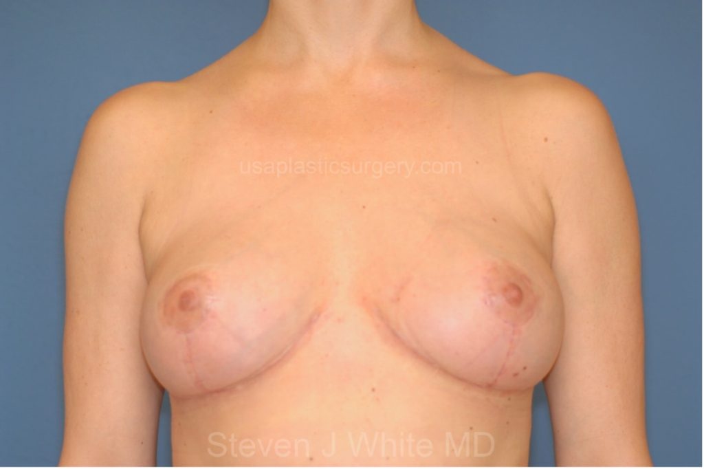Breast Implants Removal then Breast Lift – Before/After Pictures – USA Plastic Surgery-Dallas Ft Worth Texas
