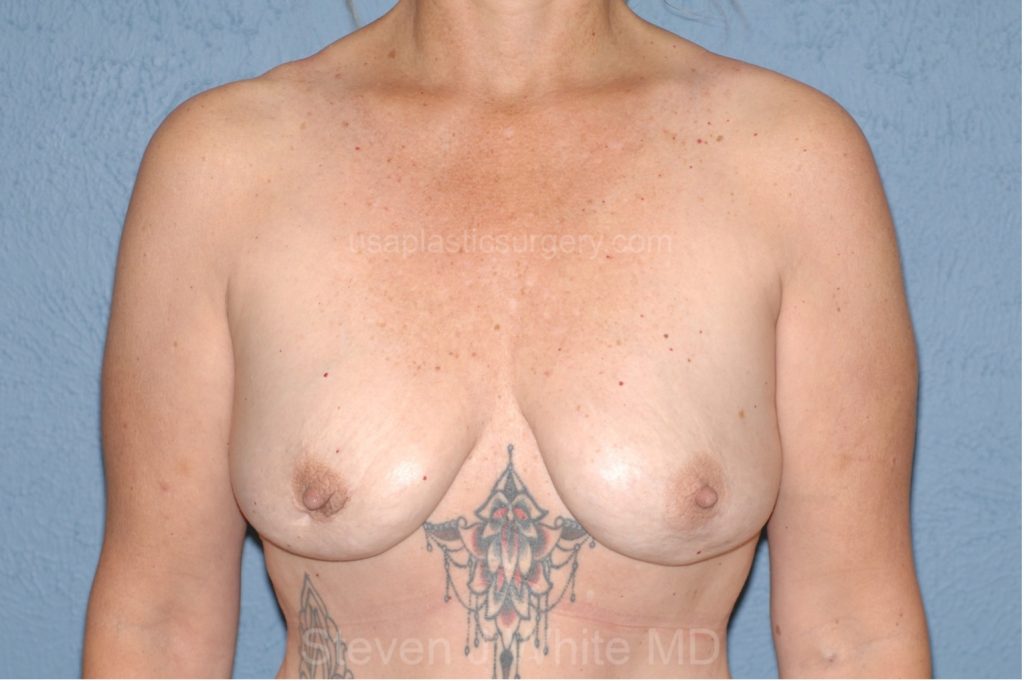 Breast Implants Removal then Breast Lift – Before/After Pictures – USA Plastic Surgery-Dallas Ft Worth Texas
