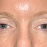 Eyelid Surgery - Blepharoplasty - Upper Eyelids Before & After Patient #5324