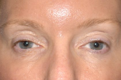 Eyelid Surgery - Blepharoplasty - Upper Eyelids Before & After Patient #5324