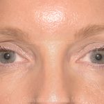 Eyelid Surgery - Blepharoplasty - Upper Eyelids Before & After Patient #5324
