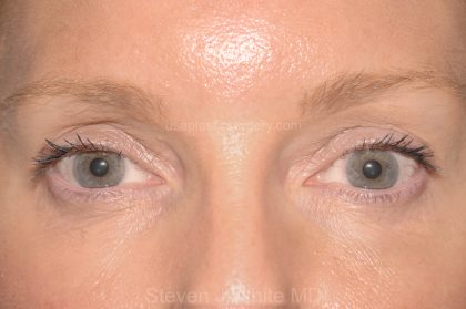 Eyelid Surgery - Blepharoplasty - Upper Eyelids Before & After Patient #5324