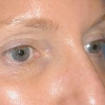 Eyelid Surgery - Blepharoplasty - Upper Eyelids Before & After Patient #5324