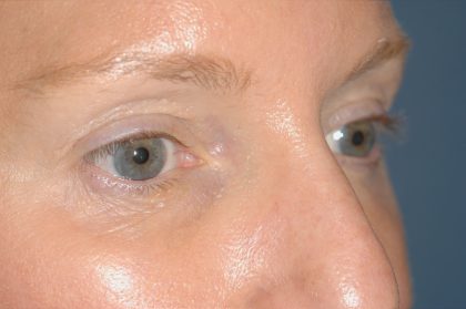 Eyelid Surgery - Blepharoplasty - Upper Eyelids Before & After Patient #5324