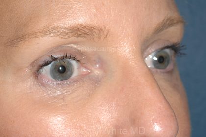 Eyelid Surgery - Blepharoplasty - Upper Eyelids Before & After Patient #5324