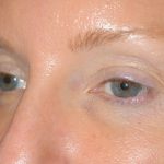 Eyelid Surgery - Blepharoplasty - Upper Eyelids Before & After Patient #5324