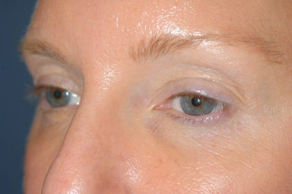 Eyelid Surgery - Blepharoplasty - Upper Eyelids Before & After Patient #5324