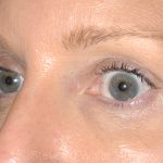 Eyelid Surgery - Blepharoplasty - Upper Eyelids Before & After Patient #5324