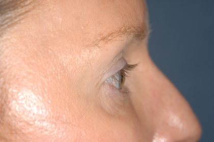Eyelid Surgery - Blepharoplasty - Upper Eyelids Before & After Patient #5324
