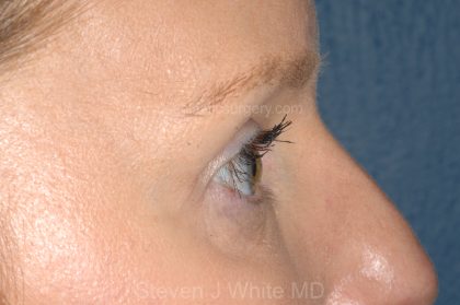 Eyelid Surgery - Blepharoplasty - Upper Eyelids Before & After Patient #5324