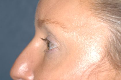 Eyelid Surgery - Blepharoplasty - Upper Eyelids Before & After Patient #5324
