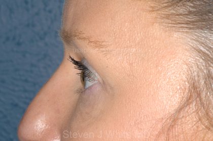 Eyelid Surgery - Blepharoplasty - Upper Eyelids Before & After Patient #5324