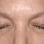 Eyelid Surgery - Blepharoplasty - Upper Eyelids Before & After Patient #5325