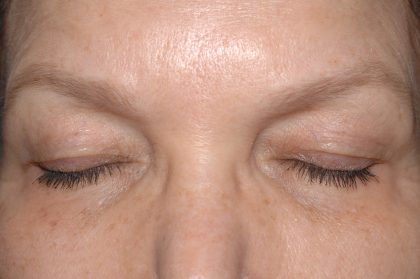 Eyelid Surgery - Blepharoplasty - Upper Eyelids Before & After Patient #5325