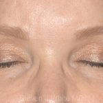 Eyelid Surgery - Blepharoplasty - Upper Eyelids Before & After Patient #5325