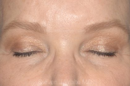 Eyelid Surgery - Blepharoplasty - Upper Eyelids Before & After Patient #5325