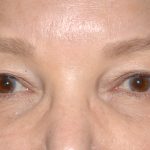 Eyelid Surgery - Blepharoplasty - Upper Eyelids Before & After Patient #5325
