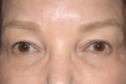 Eyelid Surgery - Blepharoplasty - Upper Eyelids Before & After Patient #5325