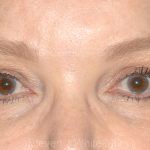 Eyelid Surgery - Blepharoplasty - Upper Eyelids Before & After Patient #5325