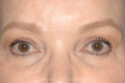 Eyelid Surgery - Blepharoplasty - Upper Eyelids Before & After Patient #5325