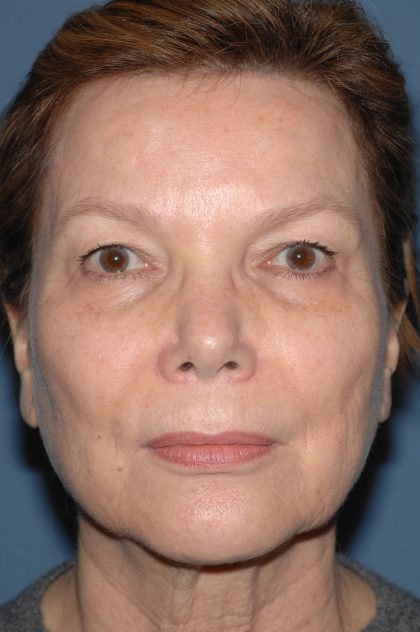 Eyelid Surgery - Blepharoplasty - Upper Eyelids Before & After Patient #5325