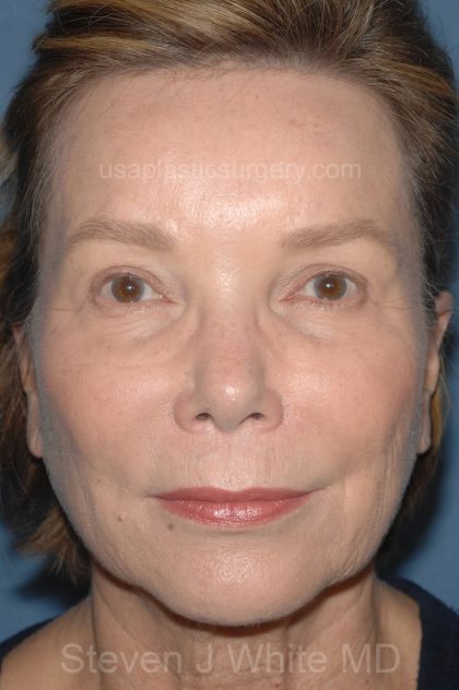 Eyelid Surgery - Blepharoplasty - Upper Eyelids Before & After Patient #5325
