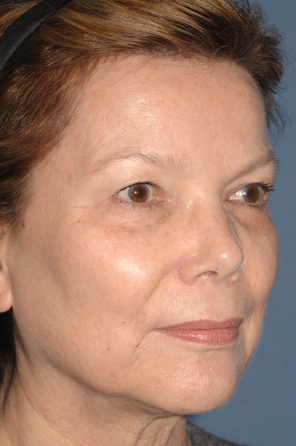 Eyelid Surgery - Blepharoplasty - Upper Eyelids Before & After Patient #5325