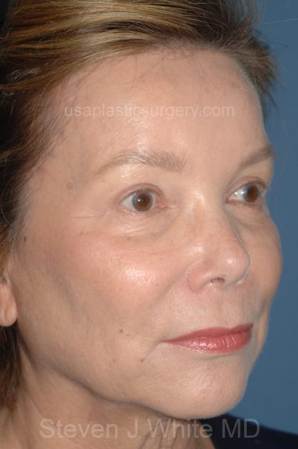 Eyelid Surgery - Blepharoplasty - Upper Eyelids Before & After Patient #5325