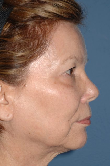 Eyelid Surgery - Blepharoplasty - Upper Eyelids Before & After Patient #5325