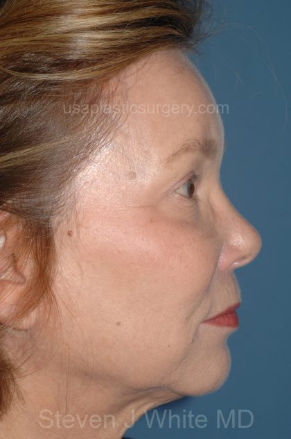 Eyelid Surgery - Blepharoplasty - Upper Eyelids Before & After Patient #5325