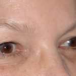 Eyelid Surgery - Blepharoplasty - Upper Eyelids Before & After Patient #5325