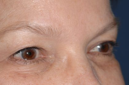 Eyelid Surgery - Blepharoplasty - Upper Eyelids Before & After Patient #5325