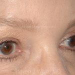 Eyelid Surgery - Blepharoplasty - Upper Eyelids Before & After Patient #5325