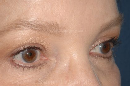 Eyelid Surgery - Blepharoplasty - Upper Eyelids Before & After Patient #5325