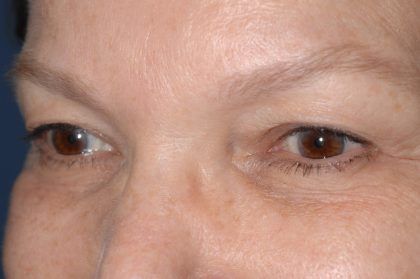 Eyelid Surgery - Blepharoplasty - Upper Eyelids Before & After Patient #5325