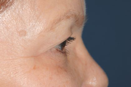 Eyelid Surgery - Blepharoplasty - Upper Eyelids Before & After Patient #5325
