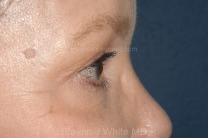 Eyelid Surgery - Blepharoplasty - Upper Eyelids Before & After Patient #5325