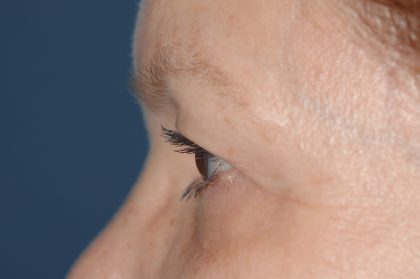 Eyelid Surgery - Blepharoplasty - Upper Eyelids Before & After Patient #5325