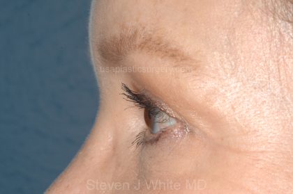 Eyelid Surgery - Blepharoplasty - Upper Eyelids Before & After Patient #5325