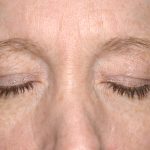 Eyelid Surgery - Blepharoplasty - Upper Eyelids Before & After Patient #5331