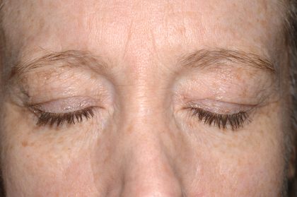 Eyelid Surgery - Blepharoplasty - Upper Eyelids Before & After Patient #5331