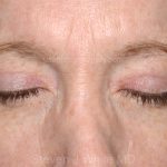 Eyelid Surgery - Blepharoplasty - Upper Eyelids Before & After Patient #5331