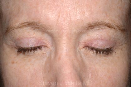 Eyelid Surgery - Blepharoplasty - Upper Eyelids Before & After Patient #5331