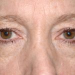 Eyelid Surgery - Blepharoplasty - Upper Eyelids Before & After Patient #5331