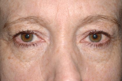 Eyelid Surgery - Blepharoplasty - Upper Eyelids Before & After Patient #5331