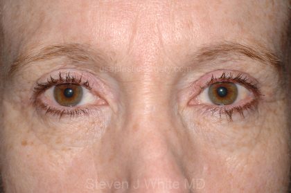 Eyelid Surgery - Blepharoplasty - Upper Eyelids Before & After Patient #5331