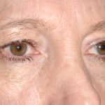 Eyelid Surgery - Blepharoplasty - Upper Eyelids Before & After Patient #5331