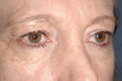 Eyelid Surgery - Blepharoplasty - Upper Eyelids Before & After Patient #5331